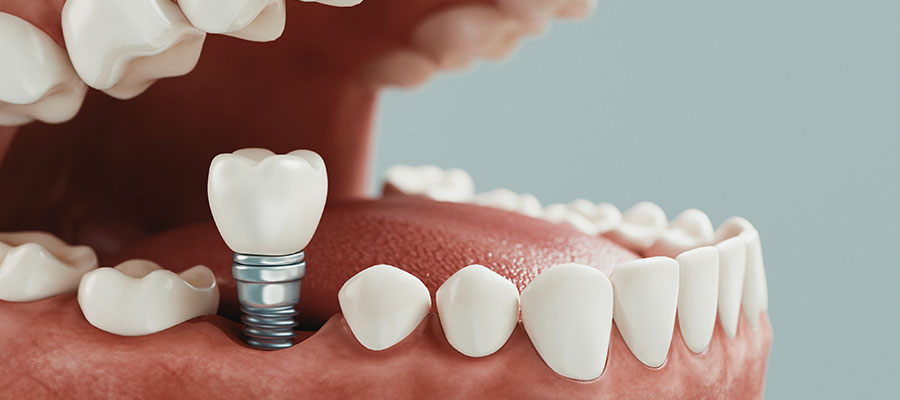 Dental Implants
