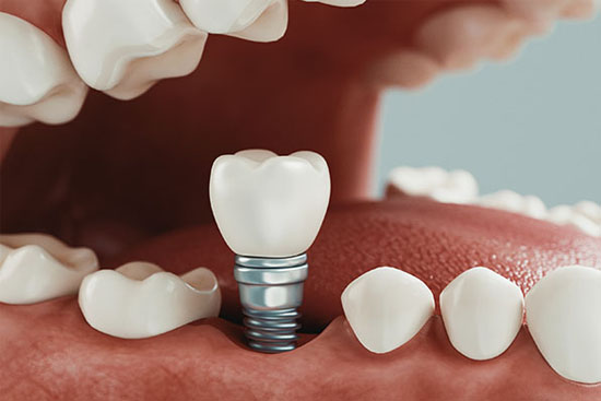 Dental Implants