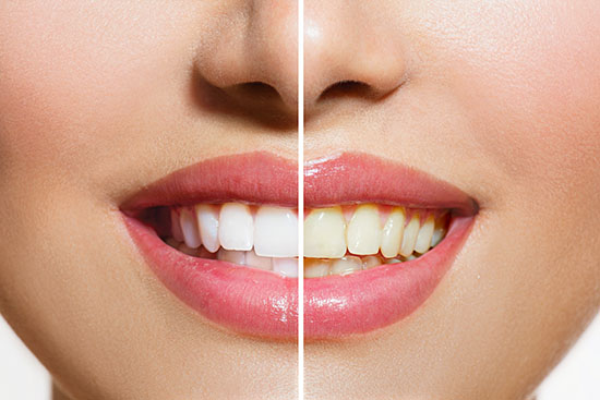 Whitening