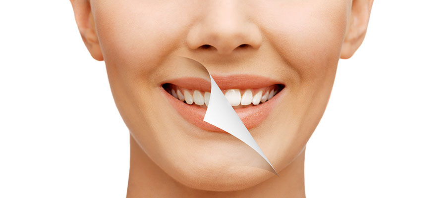 Teeth Whitening